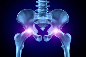 Hip Fractures