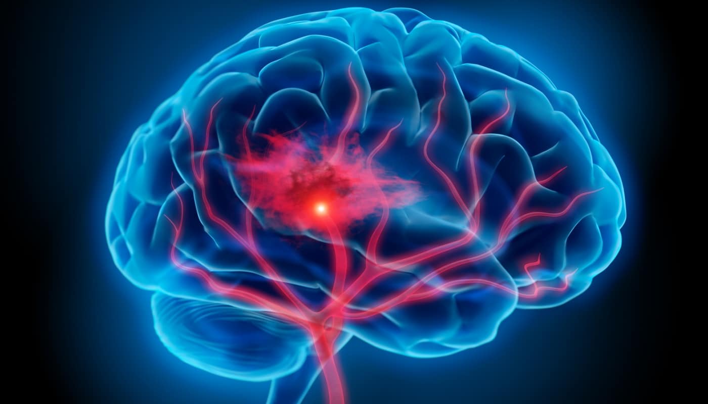 Life after Stroke