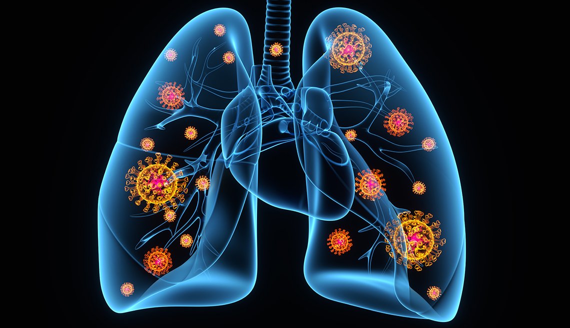 Learning about your Health: Pneumonia